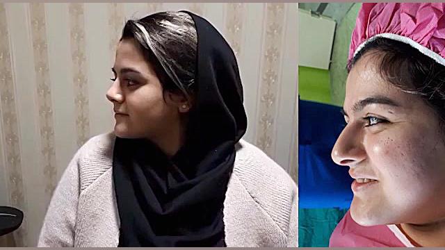 قبل و بعد از جراحی بینی | نمونه جراحی بینی | جراحی بینی کامپوزیت ونیر