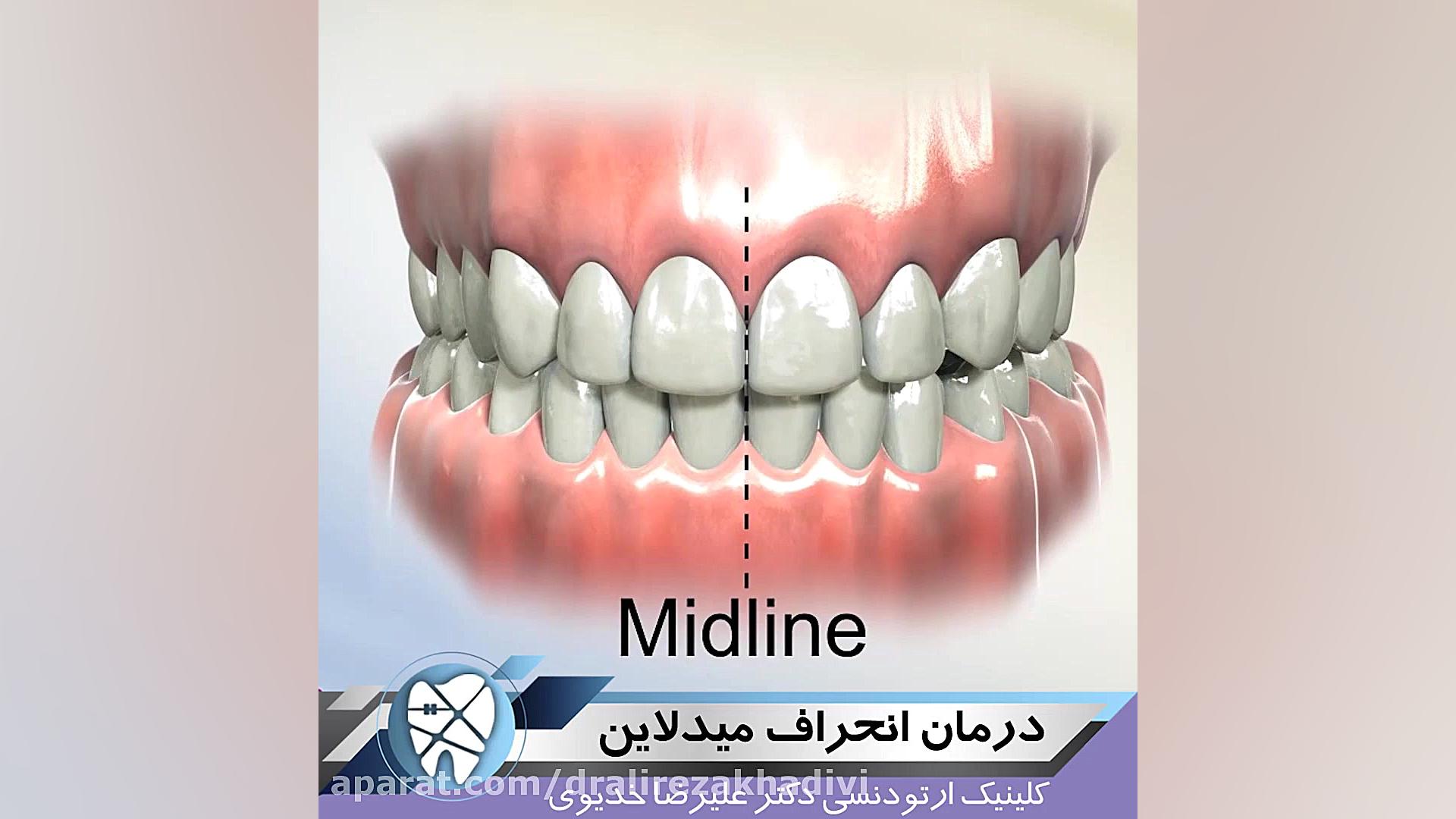 درمان انحراف میدلاین دکتر علیرضا خدیوی
