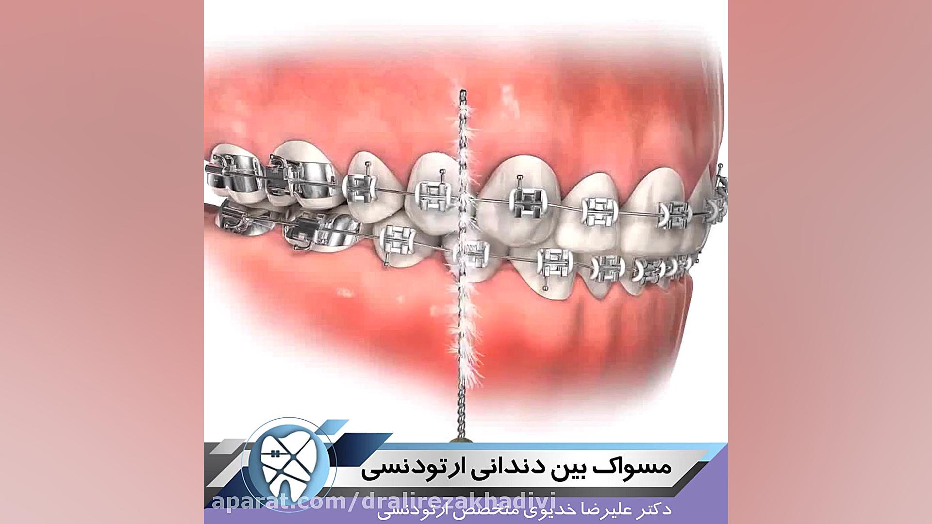 مسواک بین دندانی ارتودنسی دکتر علیرضا خدیوی