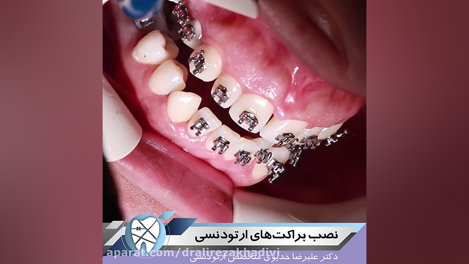 نصب براکت های ارتودنسی دکتر علیرضا خدیوی
