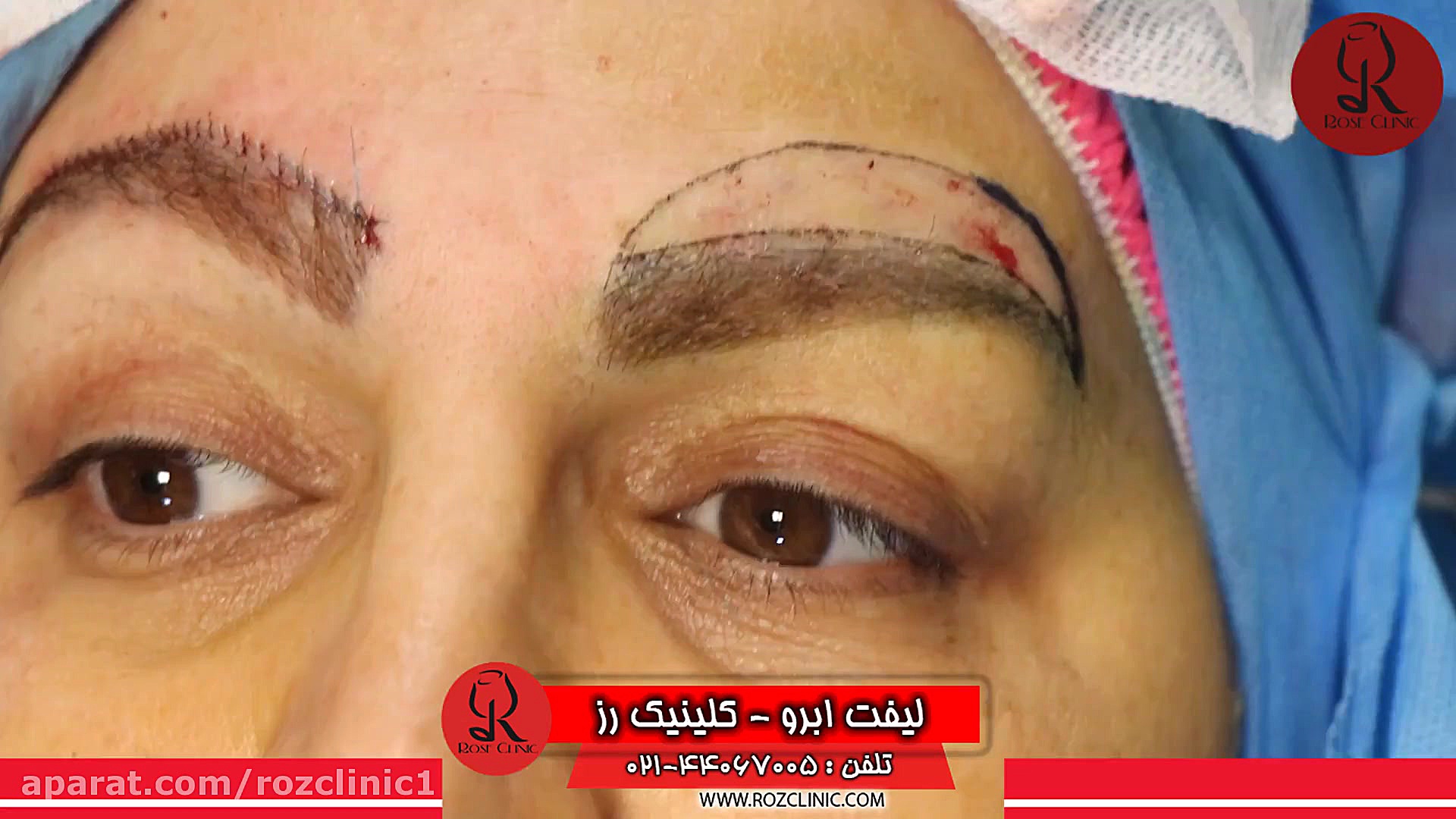 کاشت ابرو | فیلم کاشت ابرو | کلینیک پوست و مو رز | شماره57 لیفت صورت