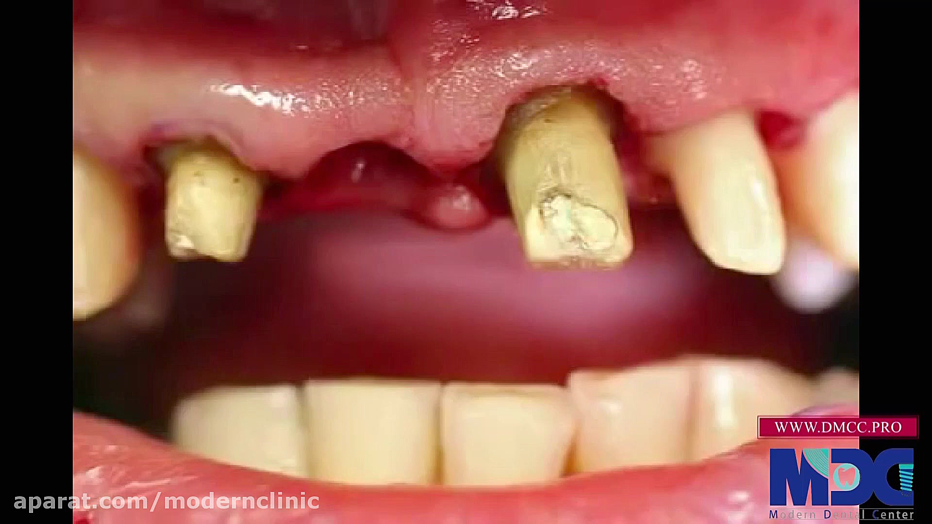 روکش دندان به جهت زیبایی|کلینیک دندانپزشکی مدرن بیولوژی تکوینی