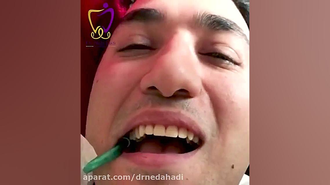 فیلم لمینت دندان | دکتر ندا هادی دکتر ندا هادی-دندانپزشک زیبایی