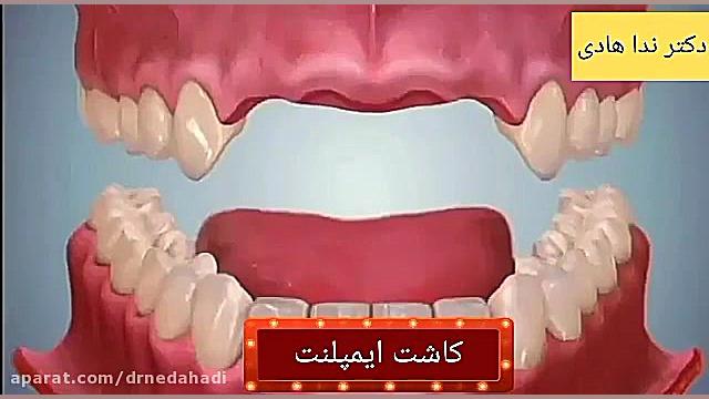 انیمیشن کاشت ایمپلنت دندان | کاشت ایمپلنت دندان دکتر ندا هادی-دندانپزشک زیبایی