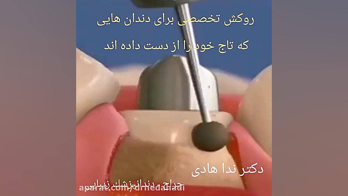 ترمیم تاج دندان | دکتر ندا هادی کامپوزیت ونیر