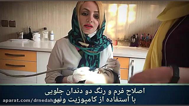 اصلاح فرم و رنگ دو دندان جلویی با استفاده از کامپوزیت ونیر دکتر ندا هادی-دندانپزشک زیبایی