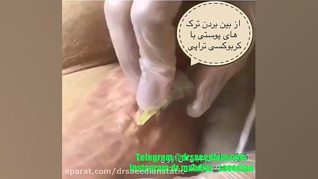 کربوکسی تراپی برای رفع ترک های پوستی سیستم نانواینژکتور