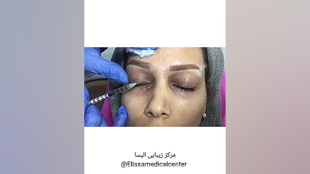 مزوتراپی دور چشم | درمان تیرگی دور چشم هایفوتراپی