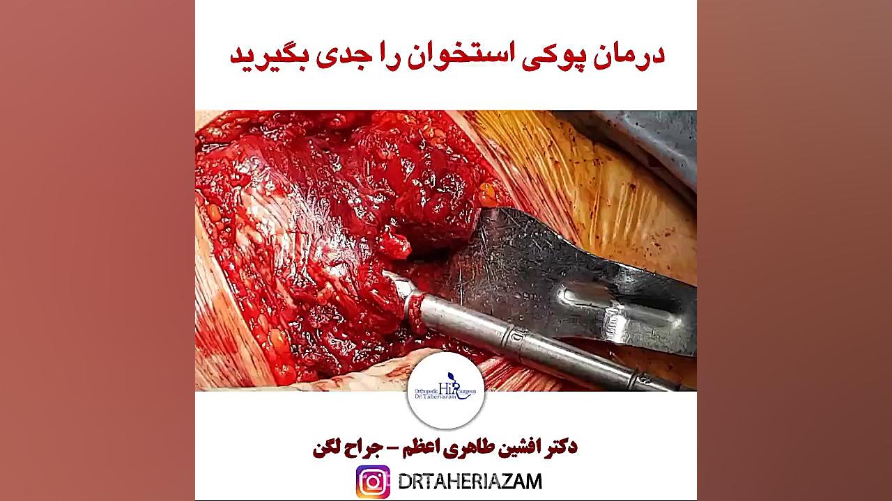 درمان پوکی استخوان را جدی بگیرید لیپوساکشن