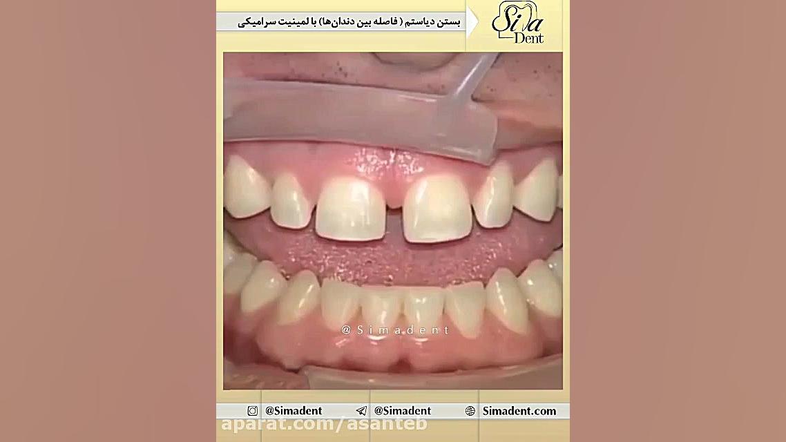 بستن فاصله بین دندان ها با لمینت سرامیکی پالبوسیکلیب