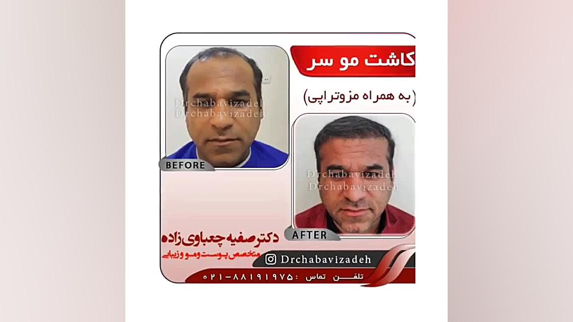 مزوتراپی مو شش ماه بعد از کاشت مو | دکتر صفیه چعباوی زاده دکتر صفیه چعباوی زاده
