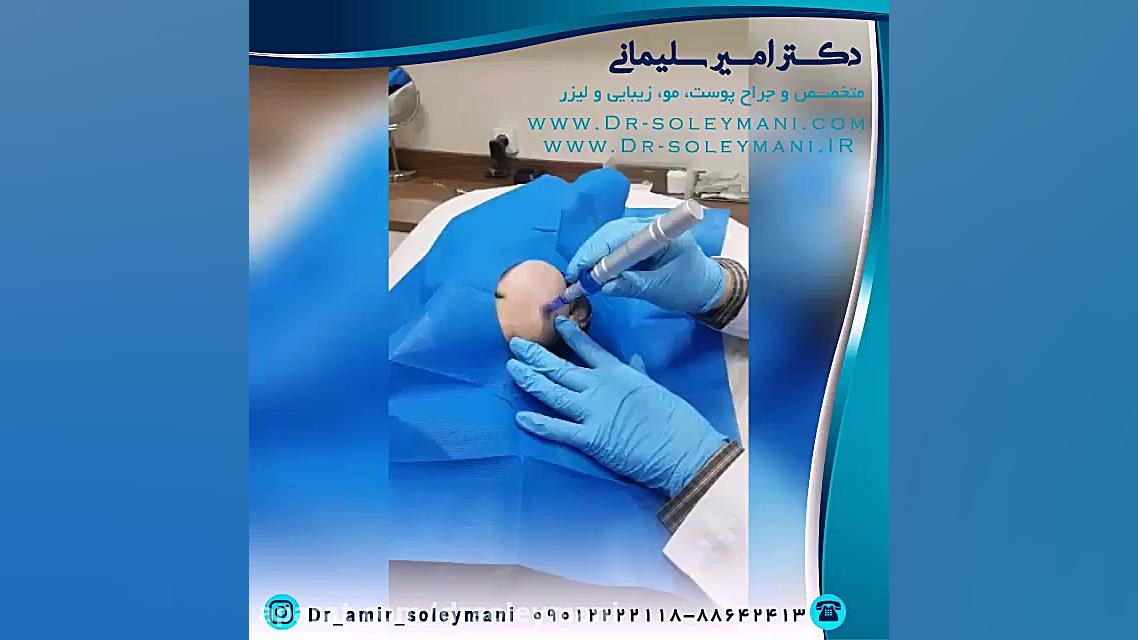 میکرونیدلینگ برای چه افرادی مناسب است دکتر امیر سلیمانی