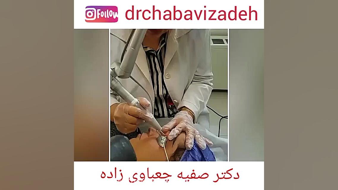 رفع گزانتوم پلک با لیزر co2 | دکتر صفیه چعباوی زاده دکتر صفیه چعباوی زاده