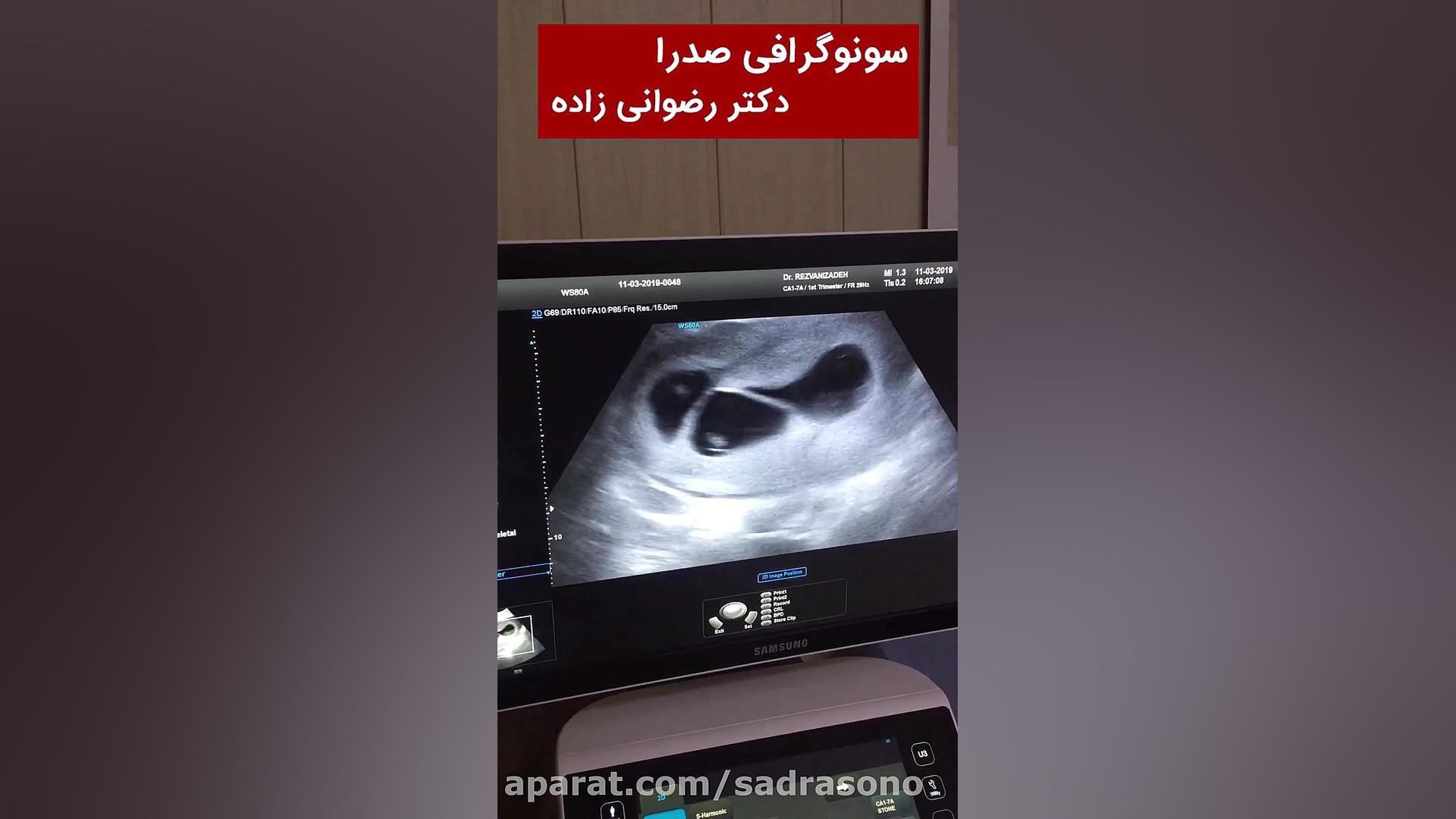 مادری با 5قلو و تزریق پتاسیم به قلب جنین ها و ... رونالدینیو