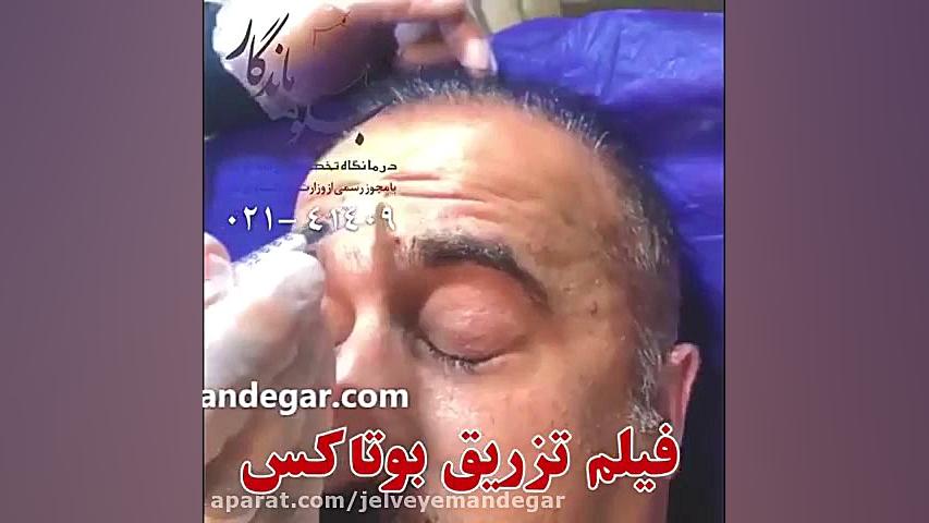 فیلم تزریق بوتاکس کلینیک مو
