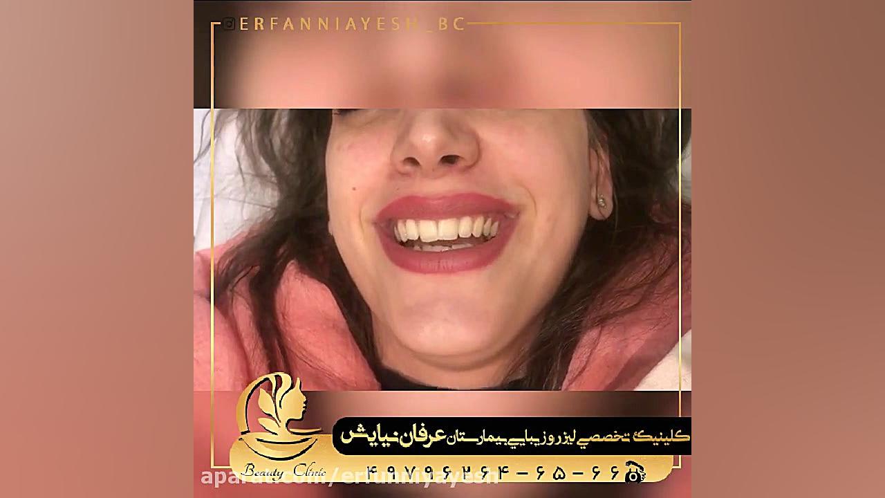 اصلاح لبخند لثه ای با بوتاکس اپی‌ژنتیک دارویی