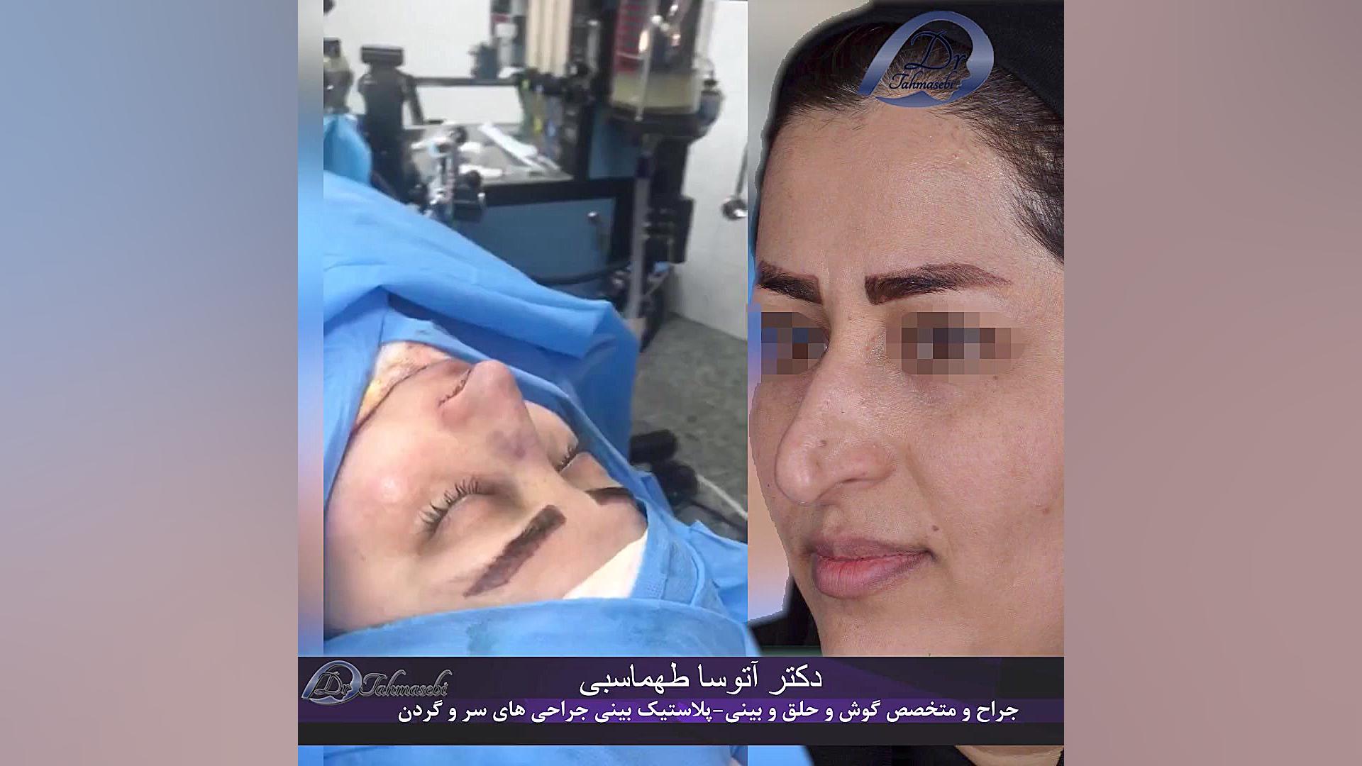اتاق عمل جراحی بینی | جراح بینی تهران عمل زیبایی