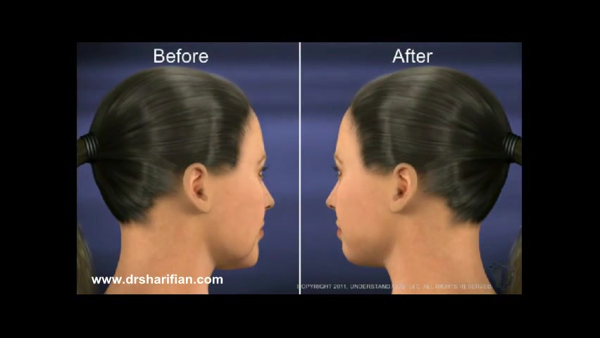 انیمیشن لیفت صورت و گردن ماستوسیتوز