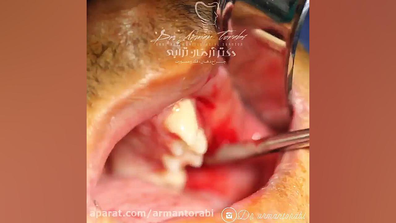 تخلیه داخل دهانی آبسه ی دندانی دکتر آرمان ترابی زاده متخصص جراحی دهان، فک و صورت