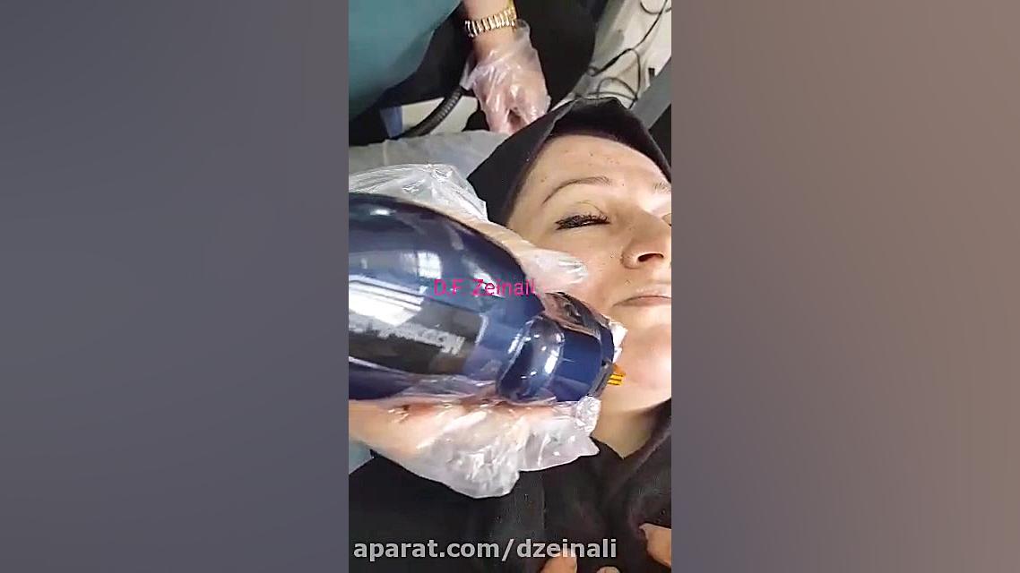 رفع اسکار آکنه وبستن منافذ باز پوست صورت با RF fractional اولتراسل دکتر فرحناز زینعلی - متخصص پوست، مو، زیبایی زنجان