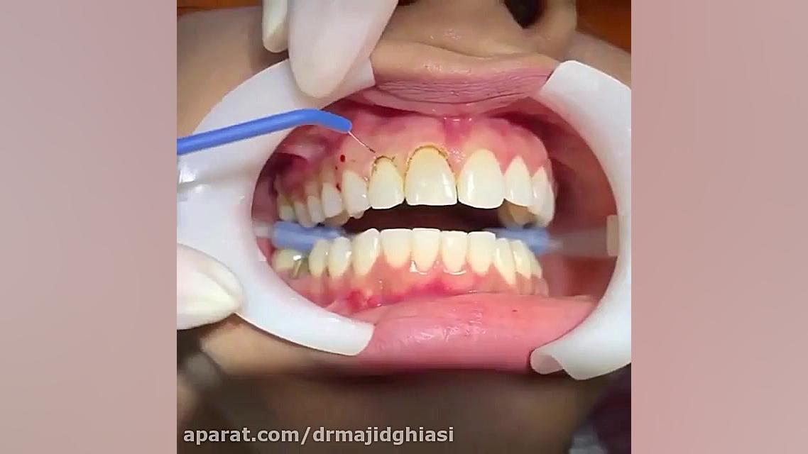 لبخند زیبا-دکترمجیدقیاسی دندانپزشک زیبایی درمشهد مزوتراپی