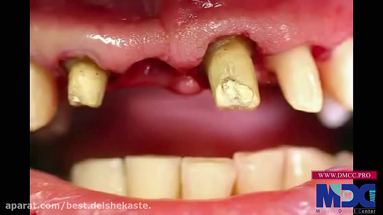 روکش دندان به جهت زیبایی-کلینیک دندانپزشکی مدرن ترمیم سوختگی