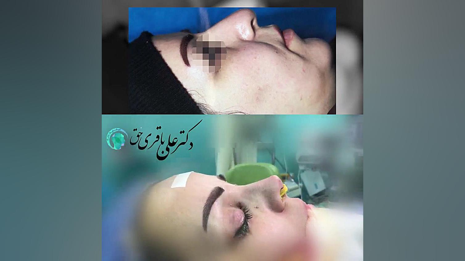 نمونه جراحی بینی گوشتی | فیلم جراحی بینی دکتر علی باقری حق