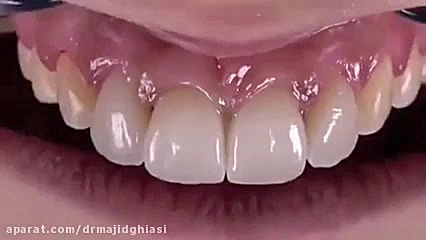 لمینت دندان-دکترمجیدقیاسی دندانپزشک زیبایی مشهد دکترمجیدقیاسی
