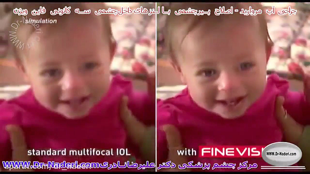 درمان پیرچشمی با لنز فاین ویژن-مرکزچشم پزشکی دکترنادری مرکز چشم پزشکی دکتر علیرضا نادری www.dr-naderi.com