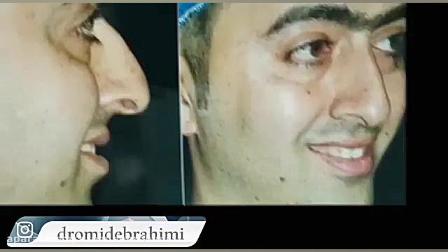 جراحی بینی استخوانی قوز دار توسط دکتر امید ابراهیمی دکتر امید ابراهیمی