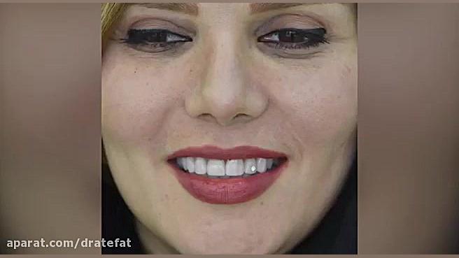 لمینیت سرامیکی 8 دندان قدامی -اصلاح طرح لبخند اصفهان دکتر محمد عاطفت متخصص ترمیمی و زیبایی اصفهان