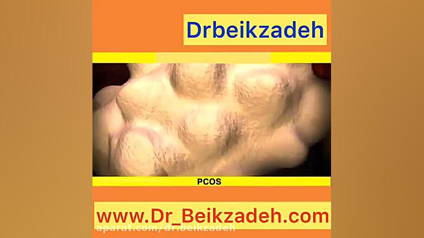 عوارض ناشی از تخمدان پلی کیستیک دکتر مژگان بیک زاده ( جراح و متخصص زنان و زایمان)