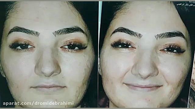 عمل زیبایی بینی توسط بهترین جراح بینی دکتر امید ابراهیمی دکتر امید ابراهیمی