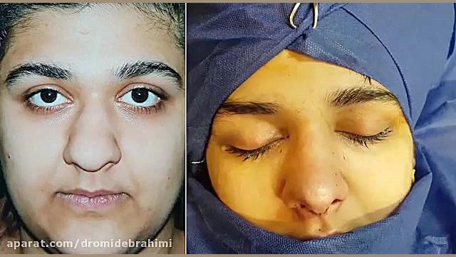 جراحی بینی گوشتی قوزدار توسط دکتر امید ابراهیمی بهترین جراح بینی دکتر امید ابراهیمی