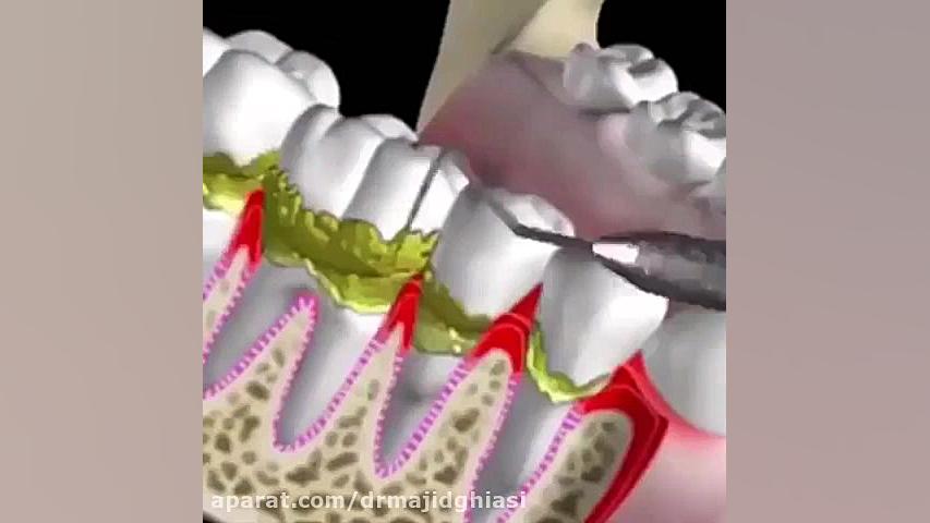 تاثیرات منفی جرم دندان بر دوام دندانها-دکترمجیدقیاسی دکترمجیدقیاسی