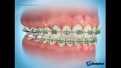 لق شدن بند ارتودنسی دکتر سهیل سالاری