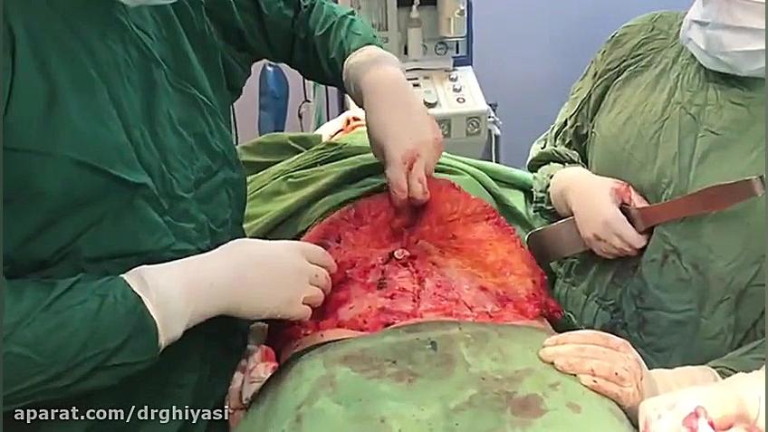 فیلم جراحی زیبایی شکم بعد از زایمان دکتر سینا غیاثی حافظی