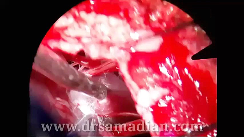همی فاشیال اسپاسم ( اسپاسم عضلات صورت) سیب زمینی بخارپز