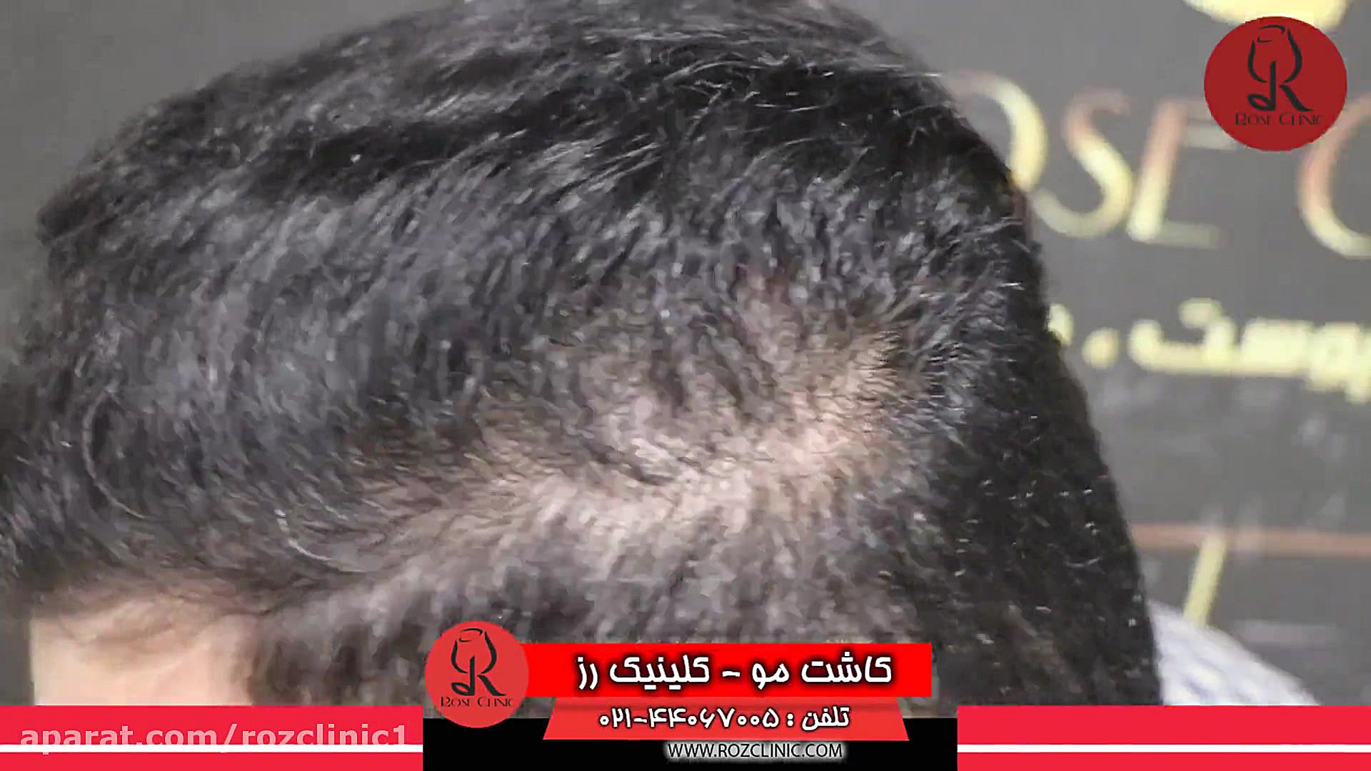 کاشت مو | فیلم کاشت مو | کلینیک پوست و مو رز | شماره24 جراحی پف زیر چشم