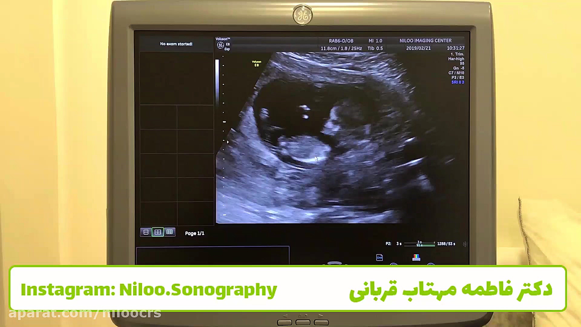 با عدد nt بین 2 و 3 چه کنیم؟ سونوگرافی نیلو دکتر فاطمه مهتاب قربانی