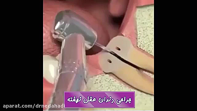 نحوه جراحی دندان عقل نهفته | دکتر ندا هادی جراح و دندانپزشک دکتر ندا هادی-دندانپزشک زیبایی