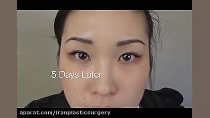 مراحل کاشت ابرو به همراه قبل و بعد کربوکسی تراپی