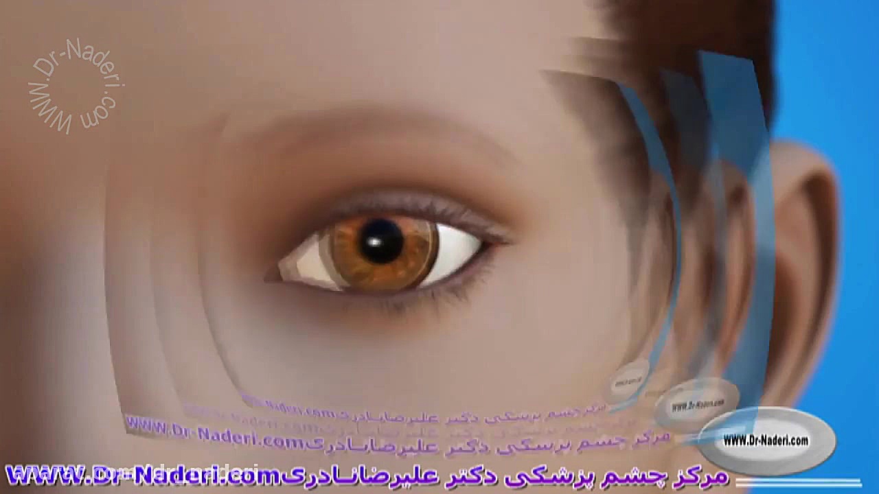 جراحی افتادگی پلک - مرکز چشم پزشکی دکتر علیرضا نادری مرکز چشم پزشکی دکتر علیرضا نادری www.dr-naderi.com