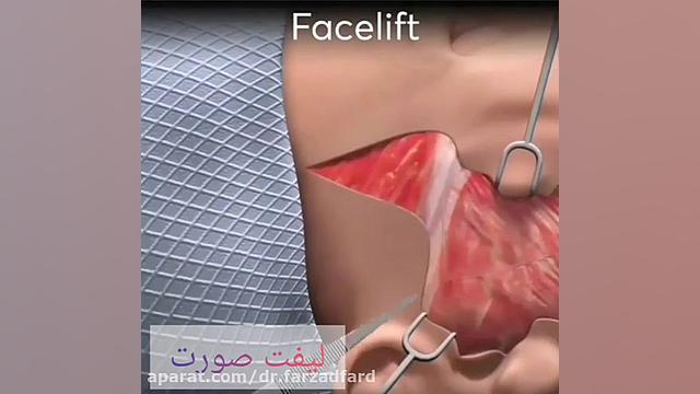 جوانسازی همراه با لیفت صورت دکتر اسماعیل فرزاد فرد - فوق تخصص پلاستیک