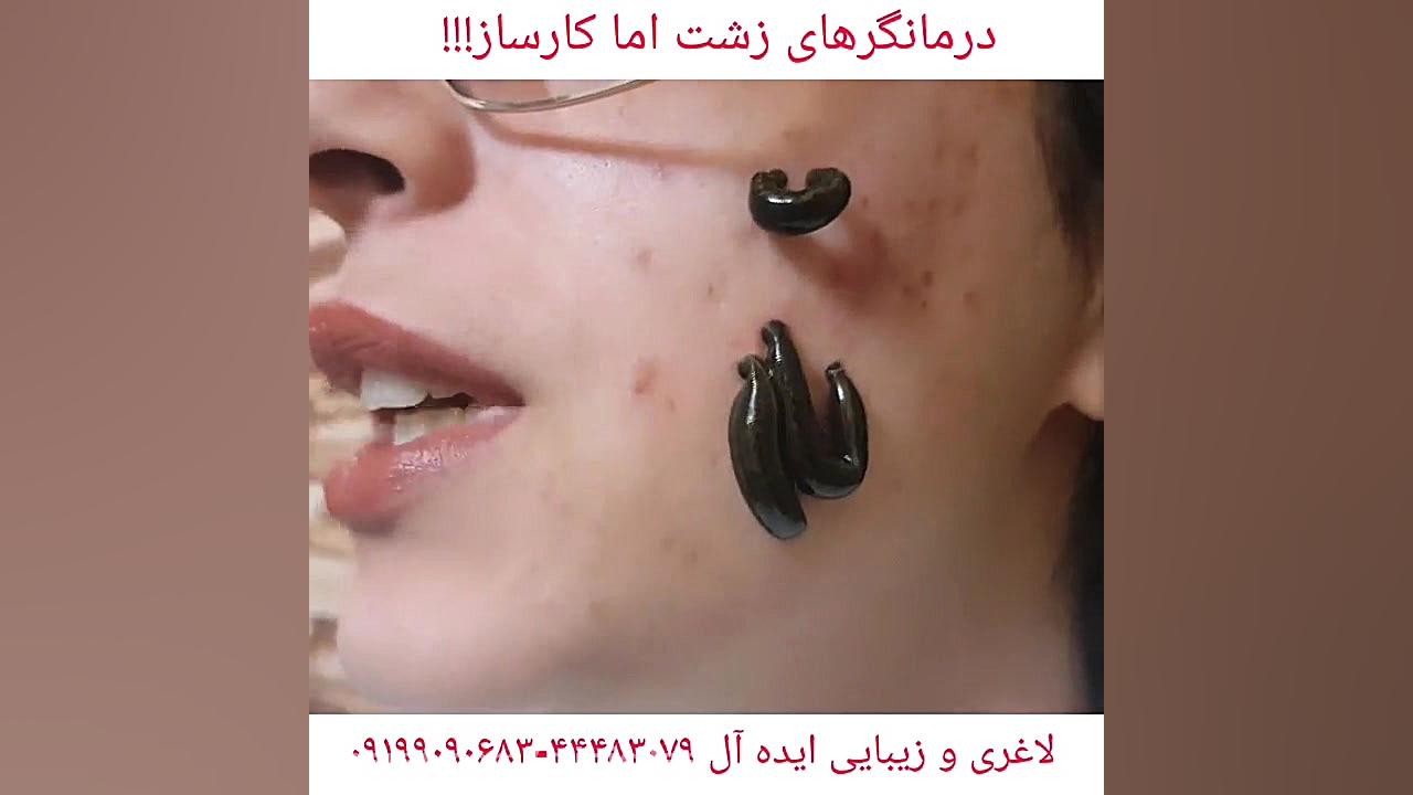 آیا زالودرمانی موجب کم خونی می شود؟ کلینیک پوست