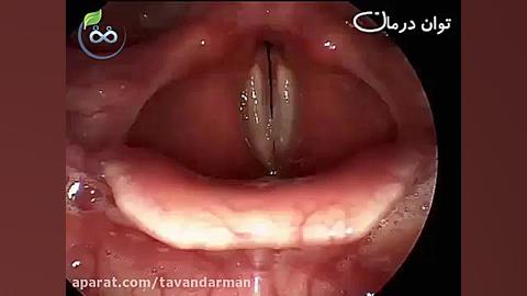 التهاب حاد حنجره (لارنژیت حاد) فالو