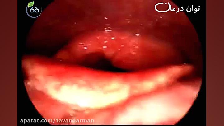 التهاب مزمن حنجره (قبل و بعد از درمان لارنژیت) رابرت داونی جونیور