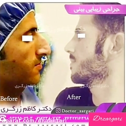 الو دکتر نمونه جراحی های بینی...