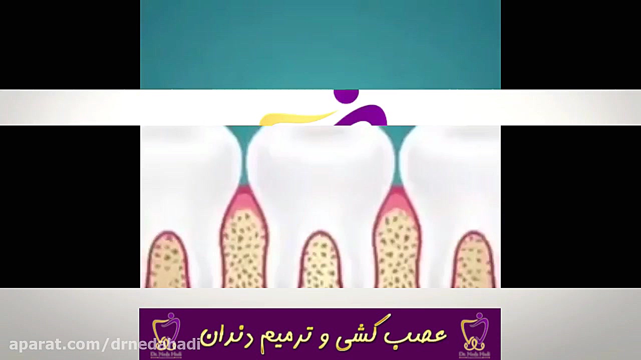 عصب کشی و ترمیم دندان | دکتر ندا هادی جراح و دندانپزشک زیبایی دکتر ندا هادی-دندانپزشک زیبایی