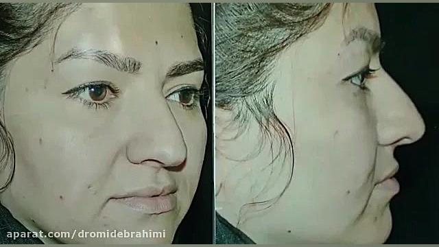 جراحی بینی گوشتی توسط دکتر امید ابراهیمی بهترین جراح بینی دکتر امید ابراهیمی